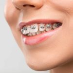 How to maintain dental health with braces or aligners
