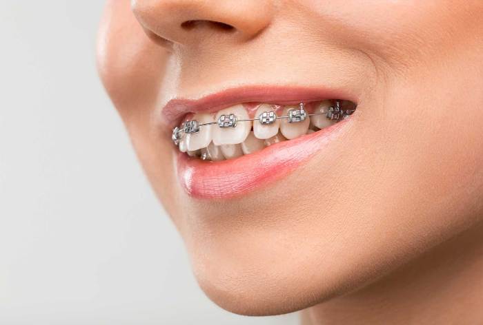How to maintain dental health with braces or aligners